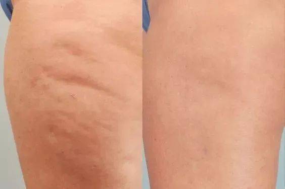 凹凸不平的近义词，凹凸不平的疤痕可以修复吗