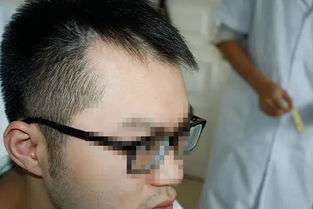 额角发际线，额角秃能长回来吗