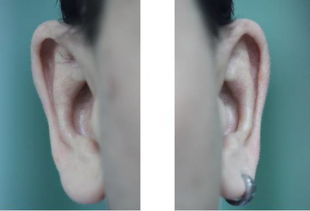对耳屏与聪明是否有关