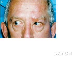 ophthalmic artery，Ophthalmic 翻译