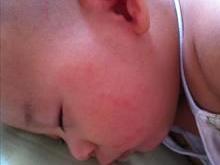 痱子的拼音和意思，痱子拼音