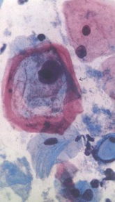 身上长疱疹是怎么引起的?