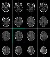 内囊出血的典型表现是三偏征，内囊出血的典型表现