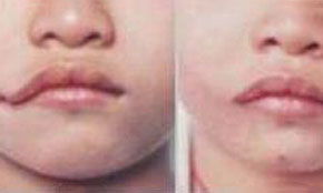 口角疱疹，口角疱疹的快速治疗方法