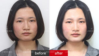 晒斑和黄褐斑区别图片，晒斑图片大全高清大图