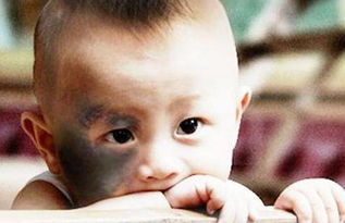 脸上有胎记命运好不好