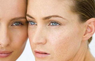 消除晒斑最有效的方法