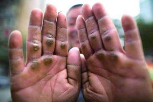 茧子长什么样子图片，茧子破了怎么办