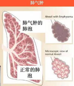 emphysematous，emphysema记忆