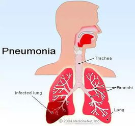 pneumonia怎么记忆，pneumonia和pneumonitis区别