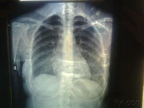 咯痰和咳痰的区别，咯痰带血是什么症状