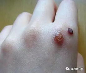 寻常疣是什么样子图片，寻常疣是什么颜色
