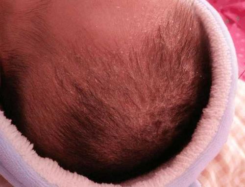 婴儿头垢比较严重,应该怎样给进行清理比较好呢?