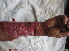 脱套伤皮肤图片，脱套伤还能治好吗