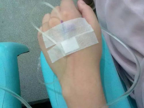 打吊针时能喝水吗?