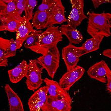 meningitis翻译，蒙特利尔