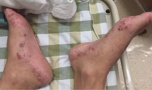 瘀血痹胶囊功效与作用，瘀血和淤血的区别