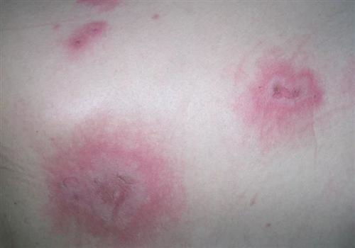 多形红斑能根治吗，多形红斑传染吗