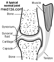 类风湿性关节炎——骨关节疾病