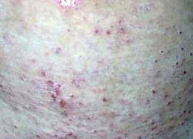 疥疮生在阴囊上怎么治疗，疥疮是因为什么原因引起的