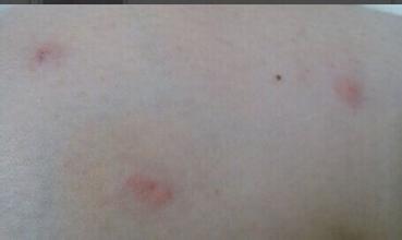 疥疮的简介,什么是疥疮