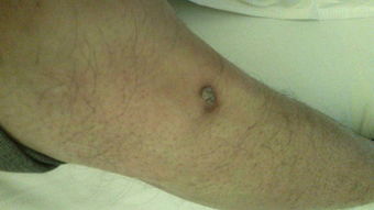 疤痕怎么才能去除，疤痕多久恢复正常肤色