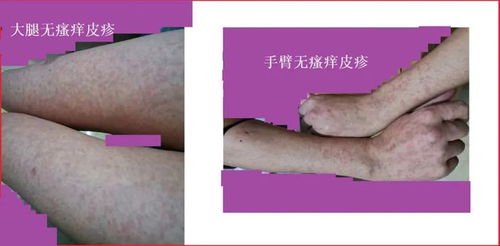 顽疾是什么意思