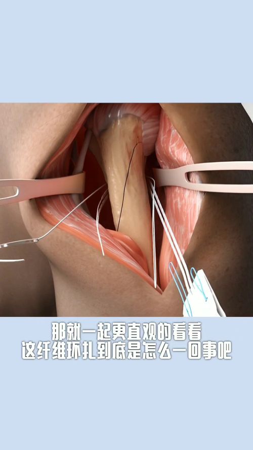 纤维环破裂如何恢复，纤维环破裂能愈合吗