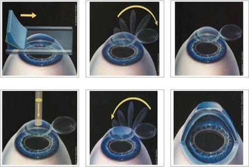 lasik是全飞秒还是半飞秒，lasika手表