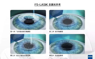 飞秒lasik是什么意思