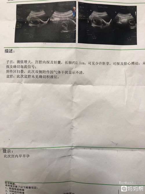 点状胚芽是什么意思，b超未见卵黄囊未见胚芽是什么意思