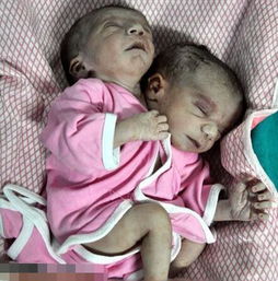 巴西双头男婴活了吗