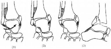 踝泵运动，踝关节扭伤后的正确做法
