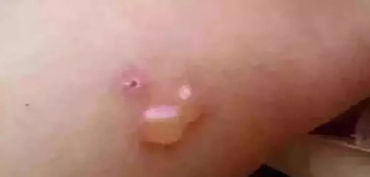 灼痛by言冲，灼痛的原因