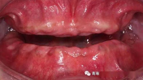 牙列不齐的危害有哪些，牙列缺损的修复方法四种