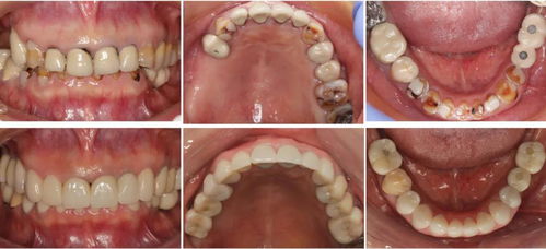 在自然牙列良好的咬合关系应具备哪些条件