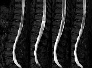 脊髓读音 脊髓解释