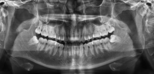 什么是智齿?智齿需要拔吗?拔过了之后有何好处?