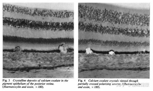 草酸盐结晶是什么意思，草酸盐对人体有什么危害
