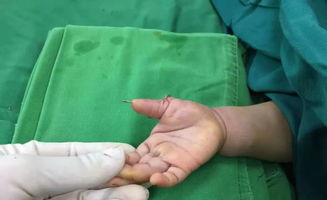 六指切除手术大概多少钱，六指金环评书全集阅读