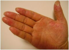 手足皲裂的原因 改善手足皲裂的方法