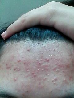 痤疮读音是什么意思