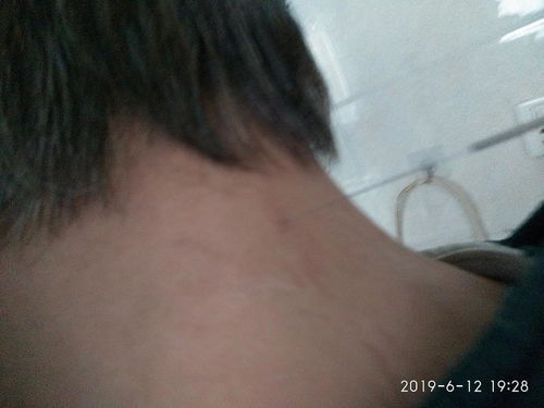 扎针对腰椎间盘突出有效果吗，扎针灸一般扎几天是一个疗程