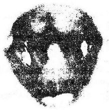 咽白喉图片，咽白喉能完全治好吗?