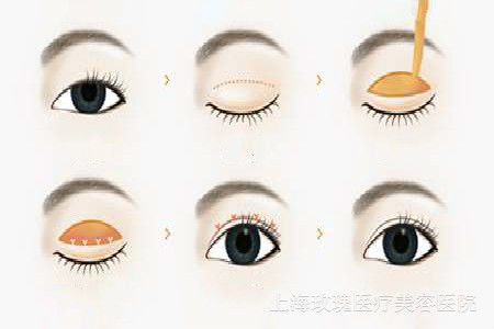 双眼皮手术的手术方法