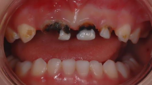 宝宝什么时候出牙?有什么症状? - 百度宝宝知道