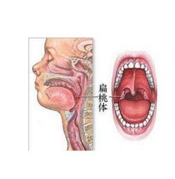 扁桃腺炎痛的无法咽口水怎么办