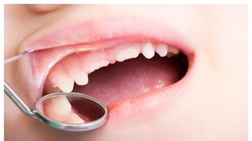 出牙晚的宝宝智商低，出牙期间有什么症状