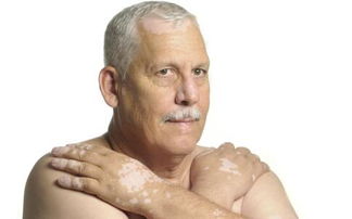 白颠疯病是什么原因北京中科地址