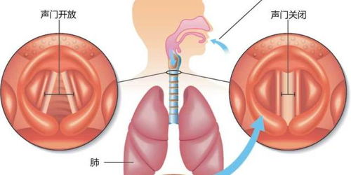 声门在哪个位置，声门裂位于
